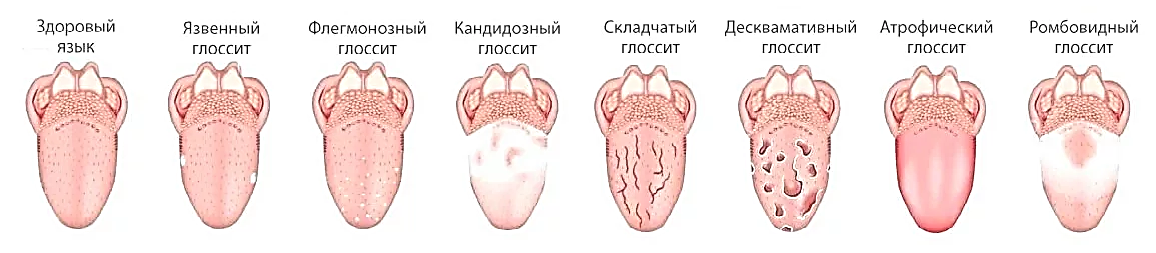 Глоссит языка симптомы фото лечение